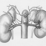 Life Without a Pancreas: What Happens to Your Body?